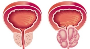 Reasons for the development of prostatitis and prostate adenoma. 